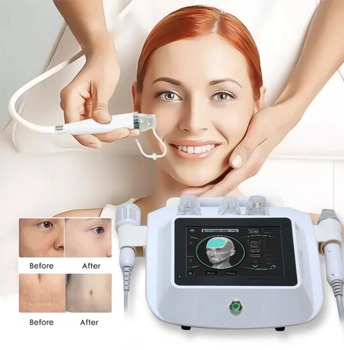 Acne Machine Acne Treatment Using Microneedle Rf/Micro Fractional Rf Einxel Plus Korea/Rf Face Lift Device