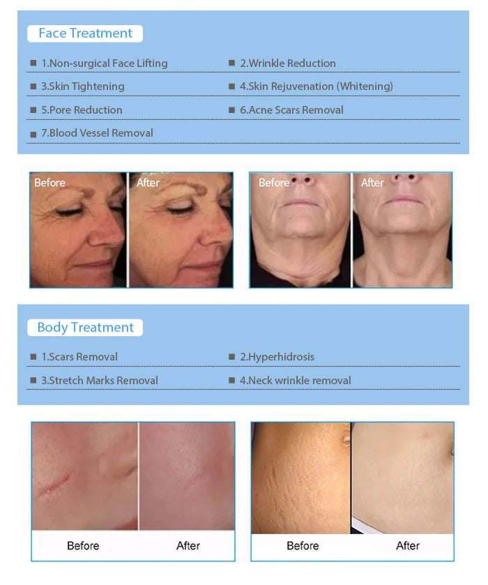 Acne Machine Acne Treatment Using Microneedle Rf/Micro Fractional Rf Einxel Plus Korea/Rf Face Lift Device